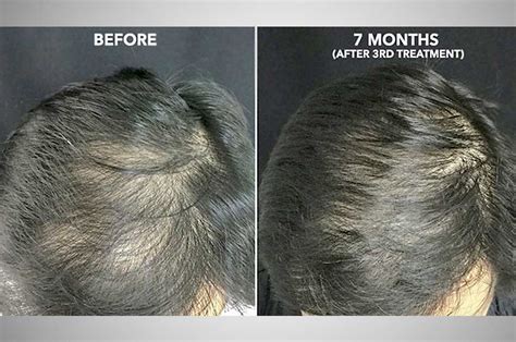The Villages PRP Regenerative Medicine .